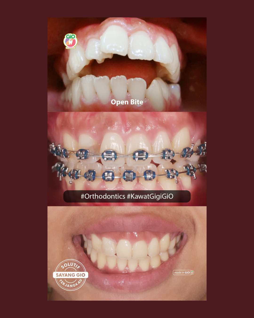 gio-kawat-gigi-american-metal-best-seller