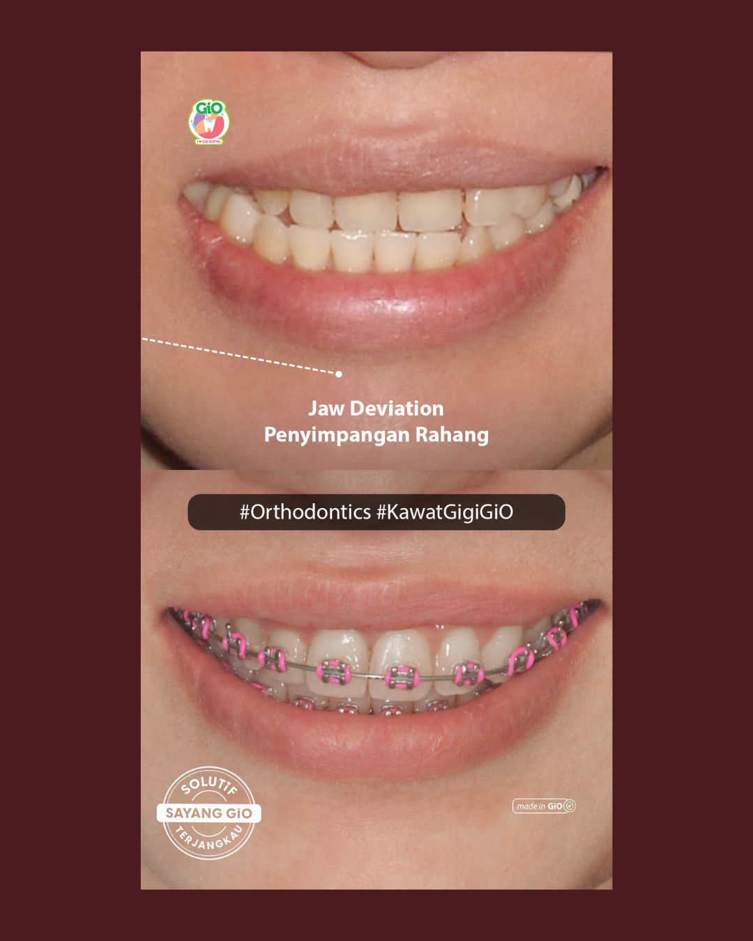 gio-kawat-gigi-american-metal-best-seller