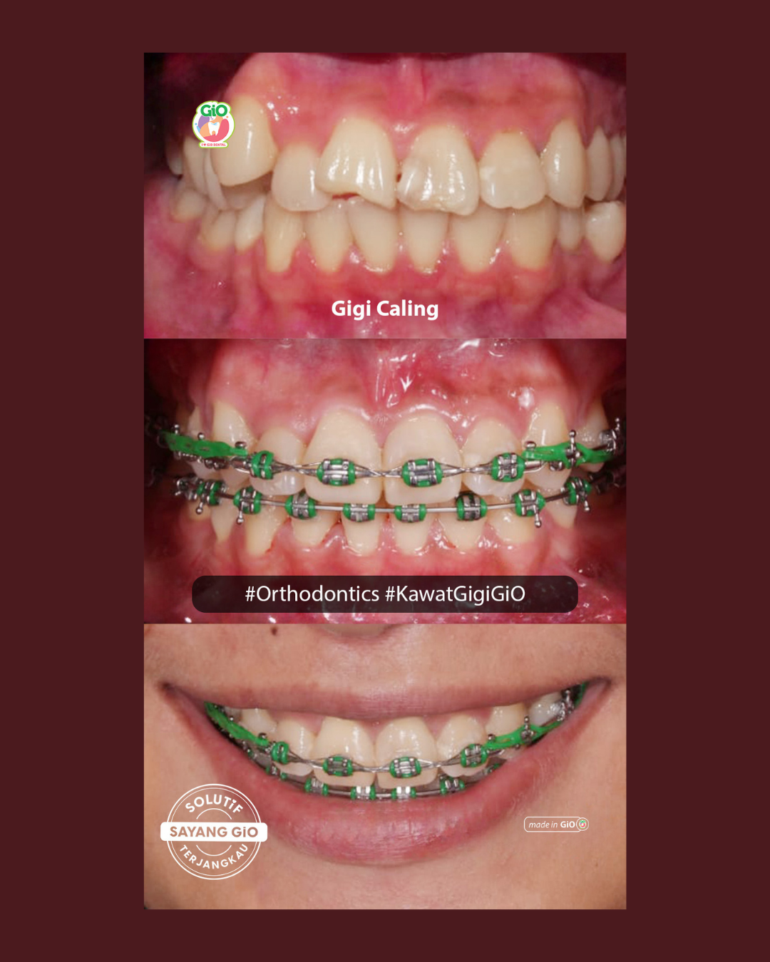 gio-kawat-gigi-american-metal-best-seller