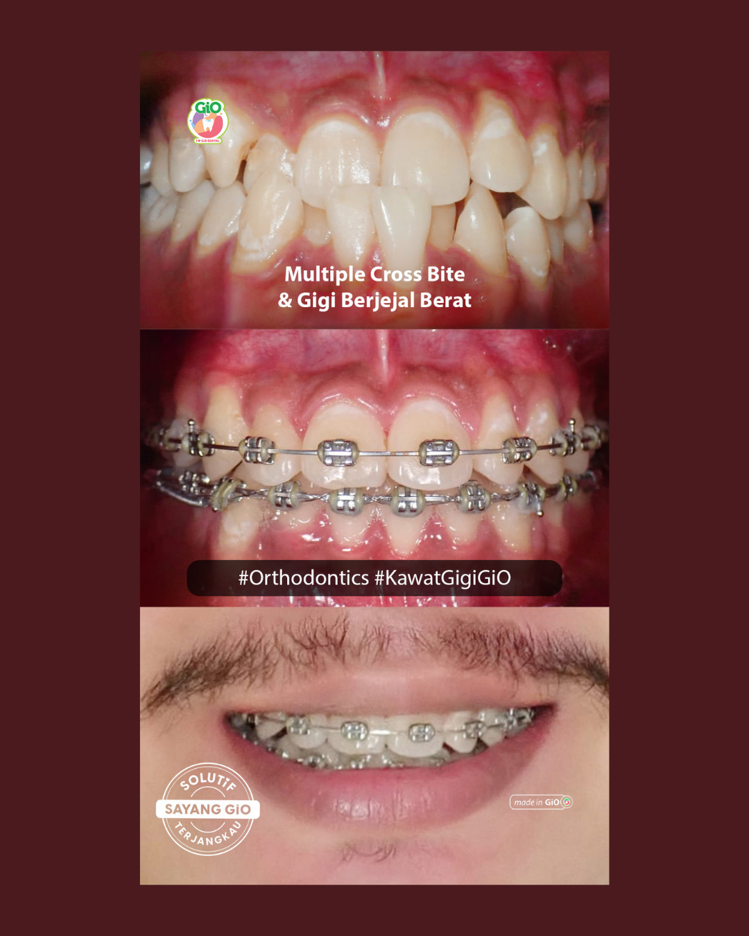 gio-kawat-gigi-american-metal-best-seller