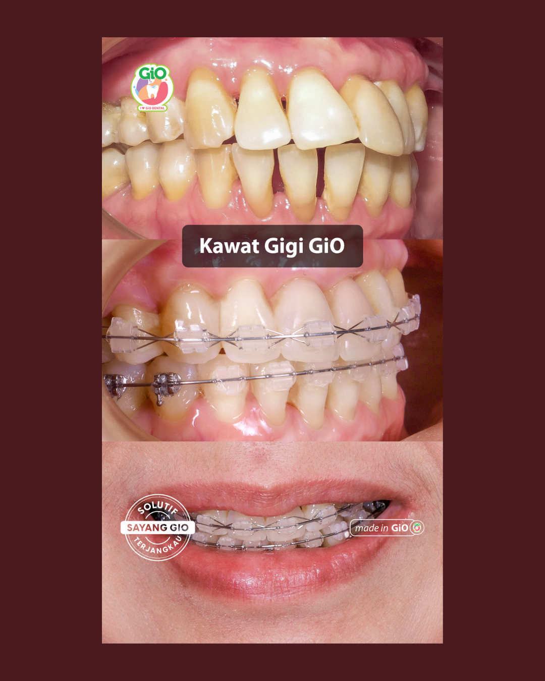 gio-kawat-gigi-transparan