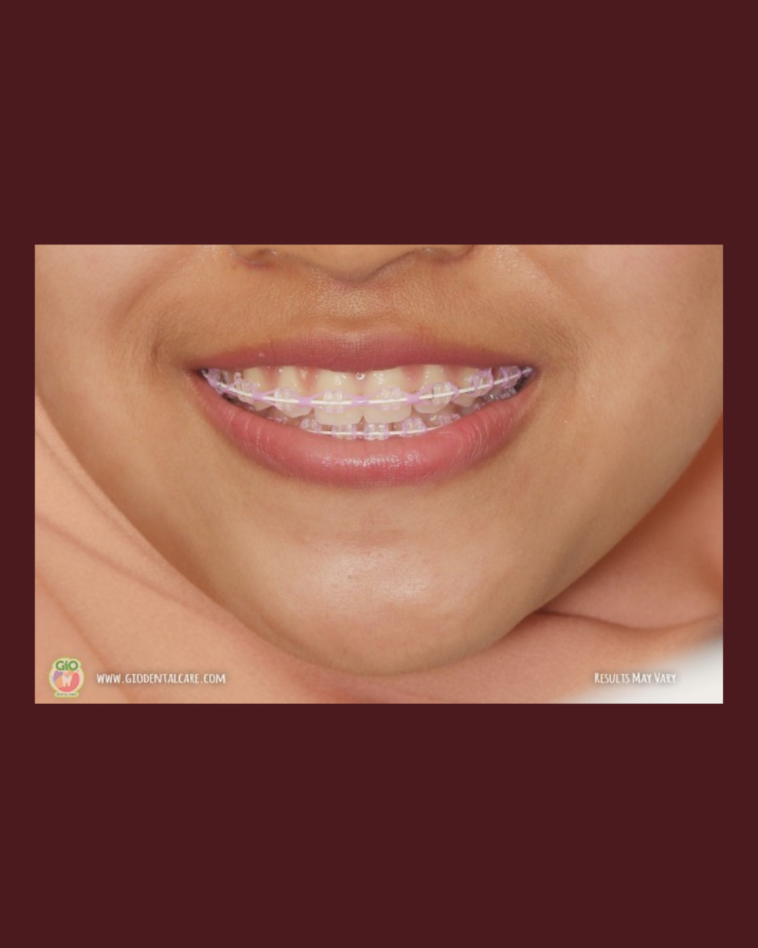 gio-kawat-gigi-transparan