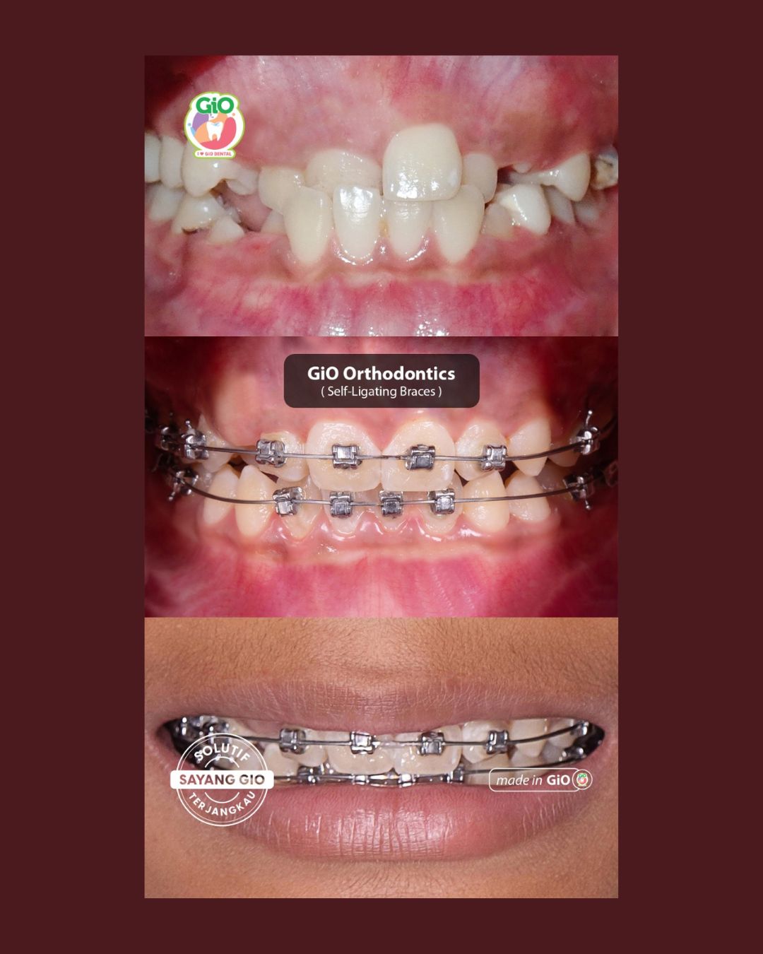 gio-self-ligating-braces