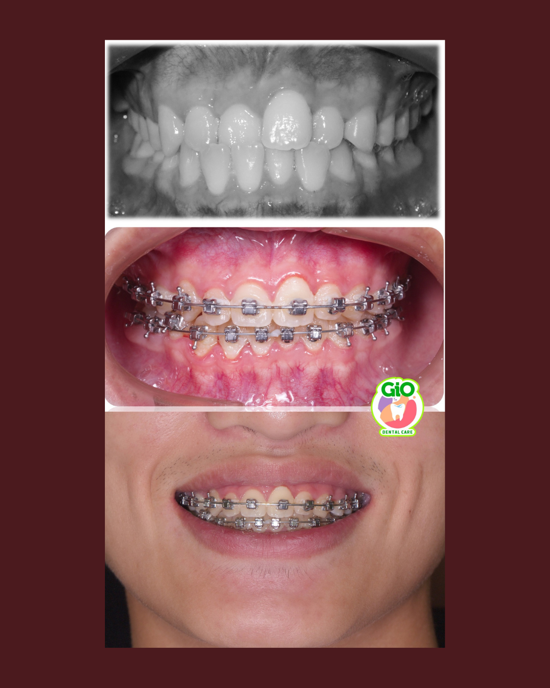 gio-self-ligating-braces