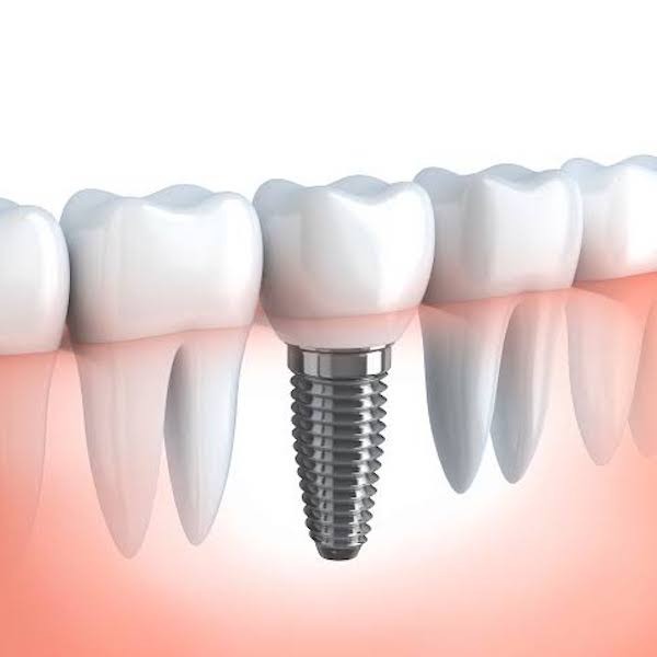 gio-dental-implants
