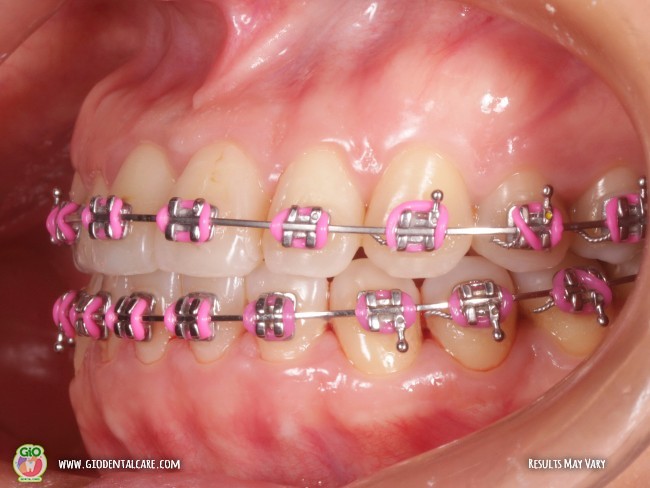 gio-kawat-gigi-american-metal-best-seller