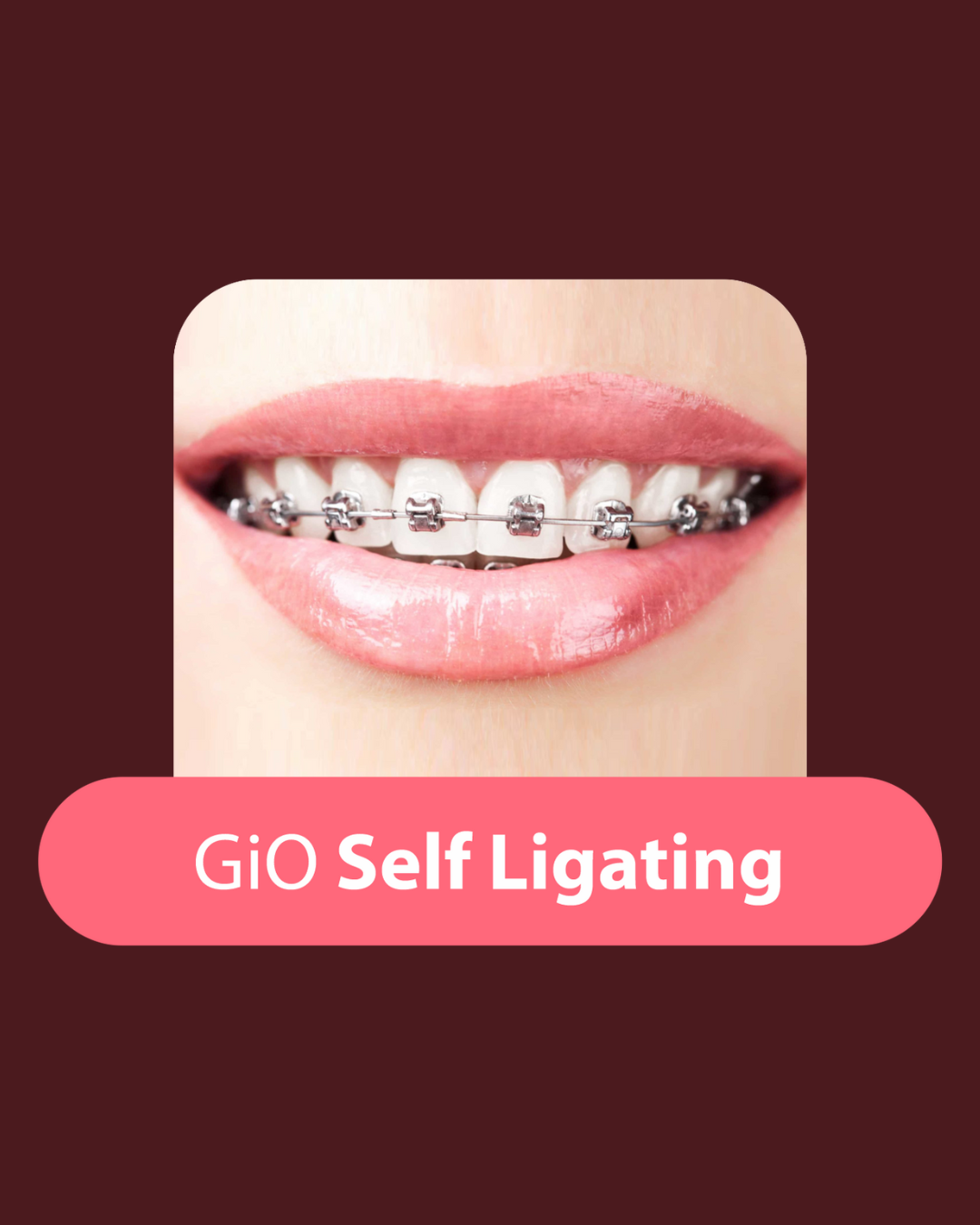 gio-self-ligating-braces
