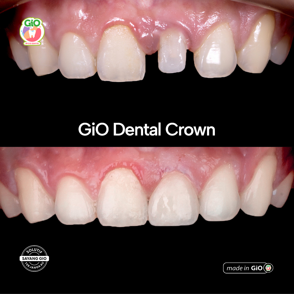 ceramic-crown-bridge