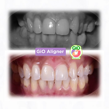 gio-aligner-gigi