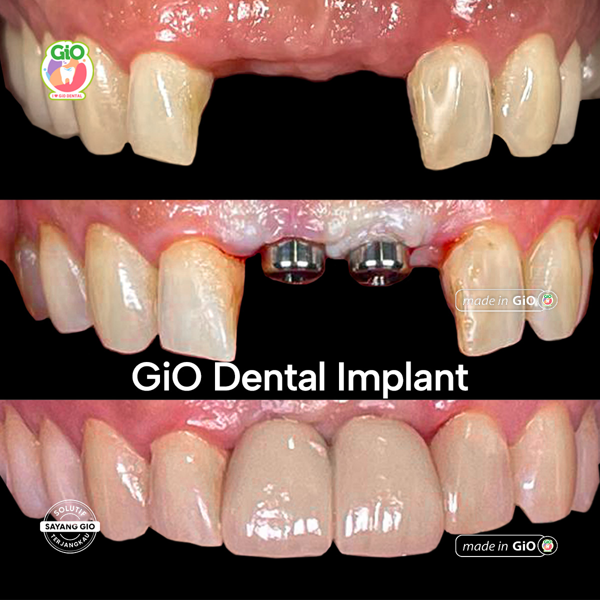 gio-ceramic-crown-bridge-and-implant