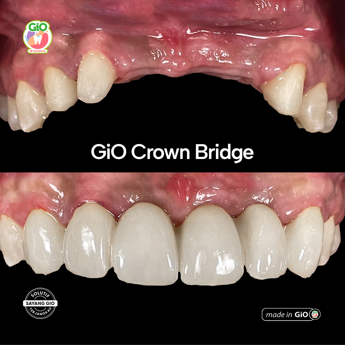 gio-ceramic-crown-bridge-and-implant
