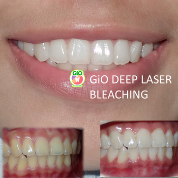 gio-deep-laser-bleaching