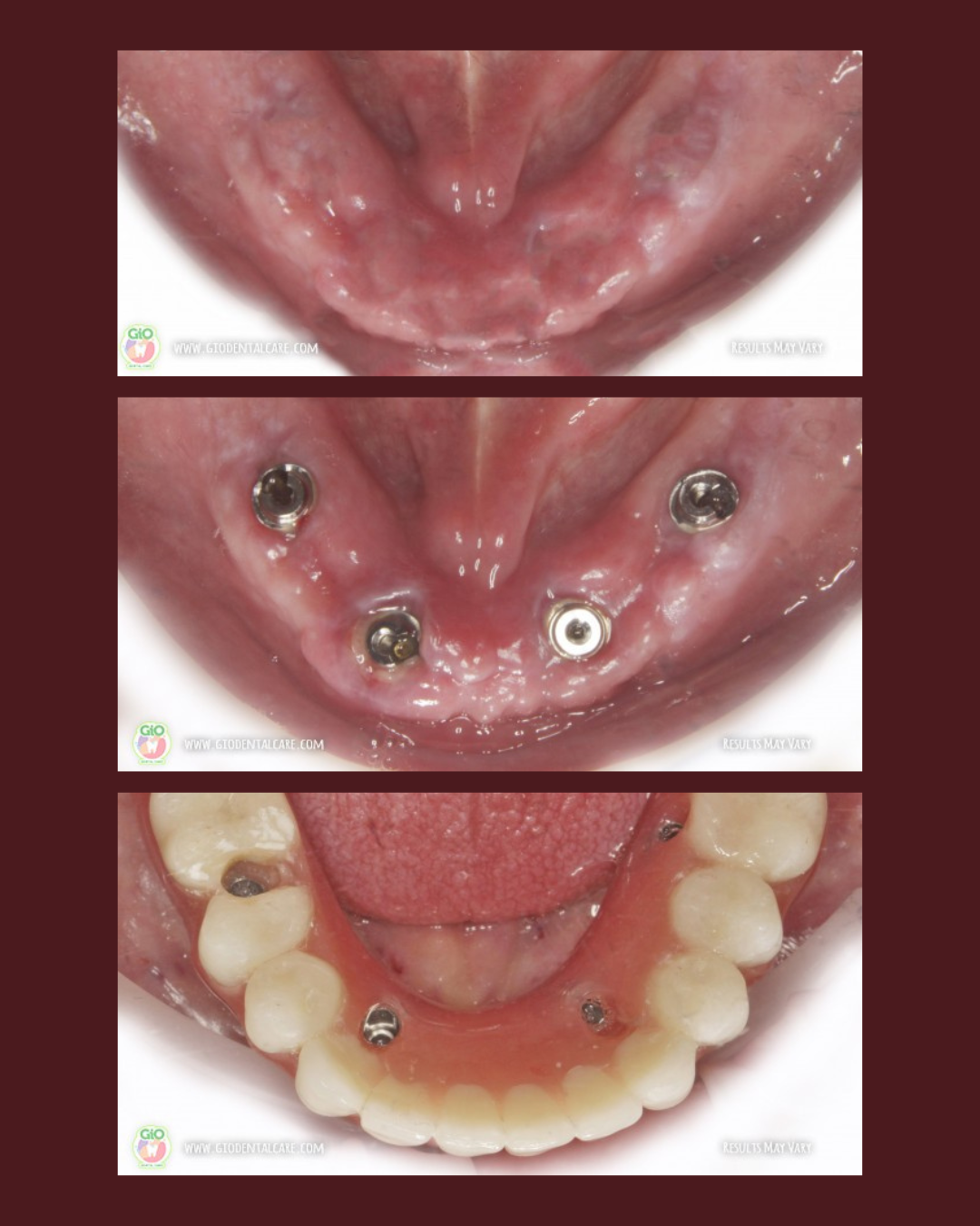 gio-dental-implants
