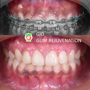 gio-gum-rejuvenation