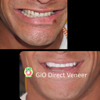 gio-healthy-veneer