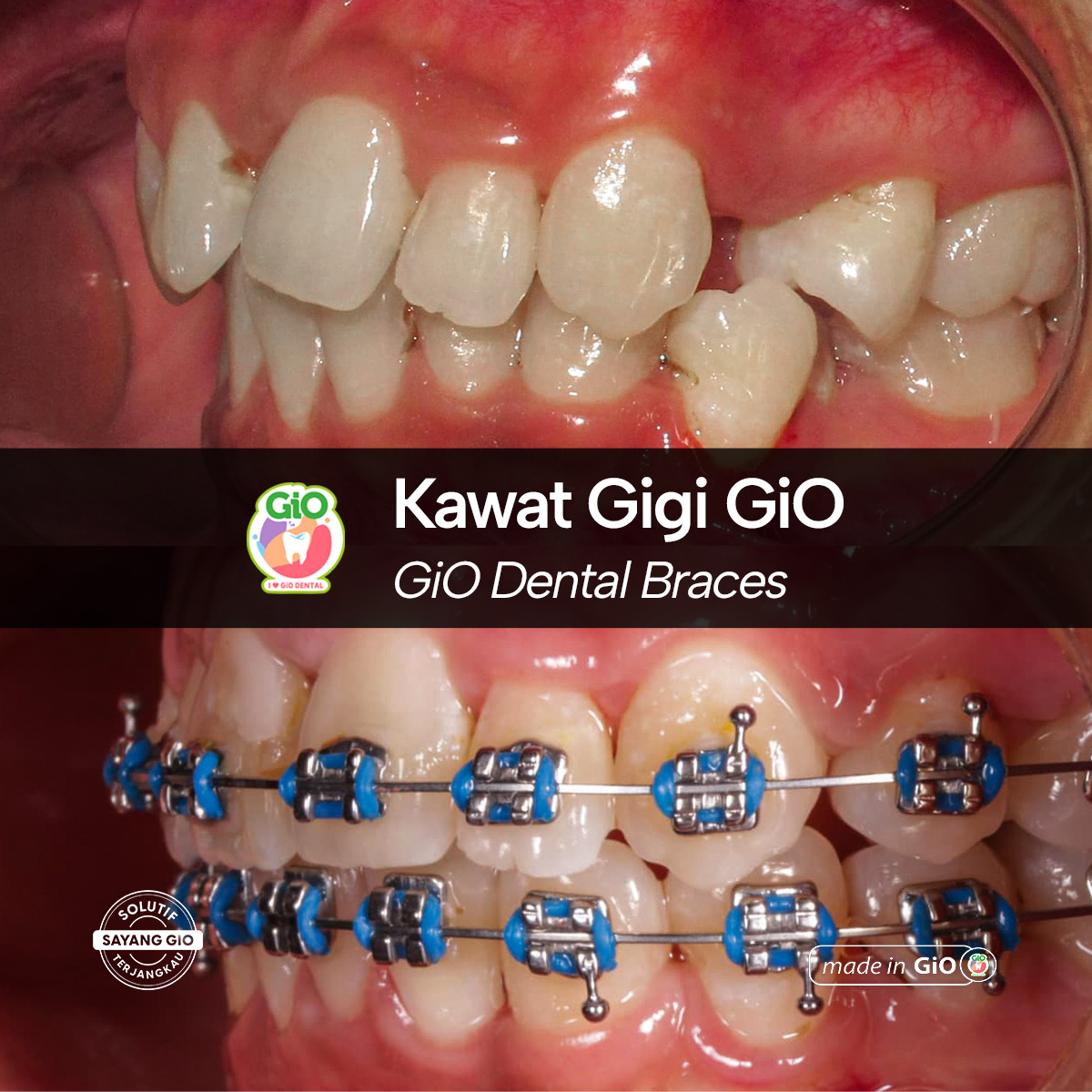 gio-kawat-gigi-transparan