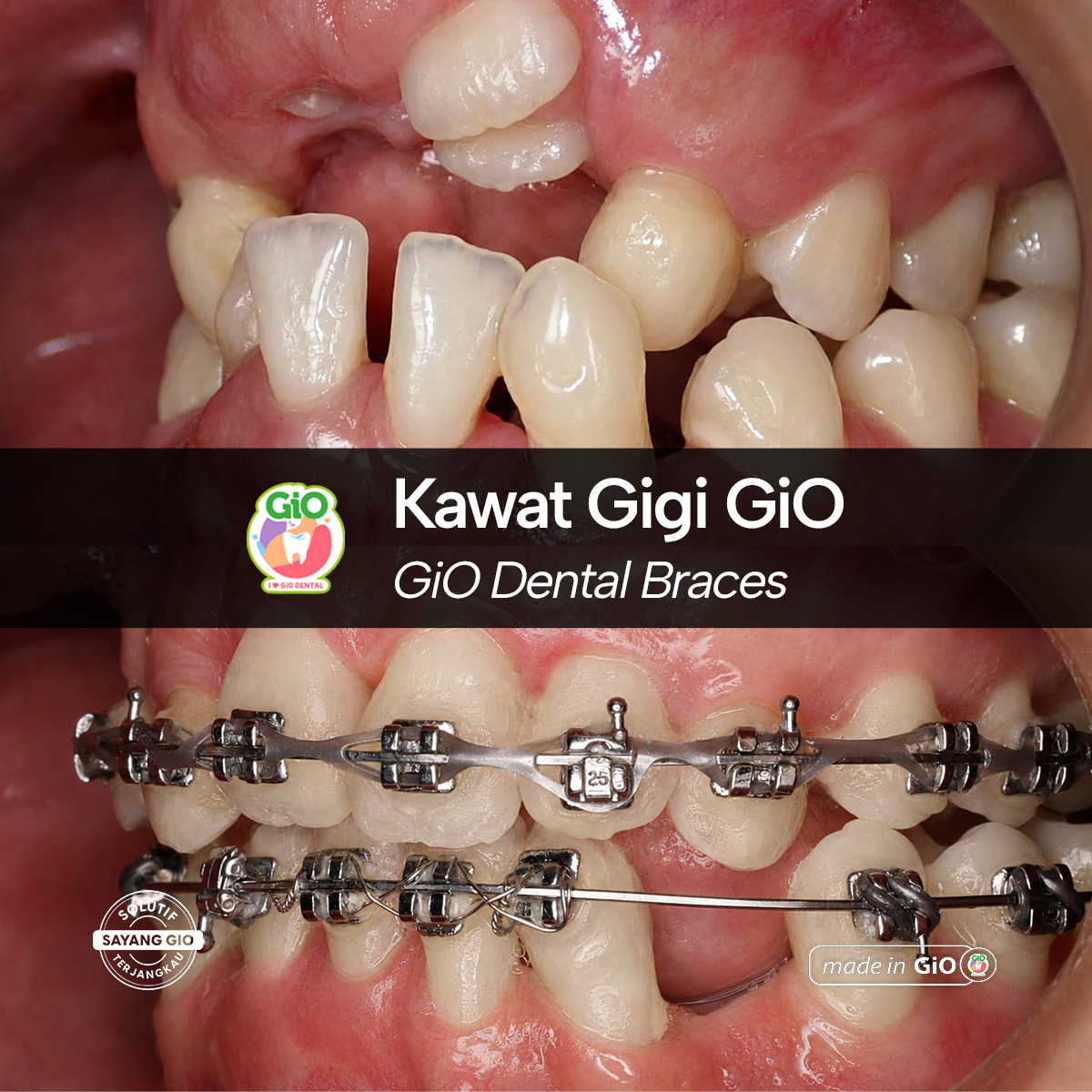 gio-self-ligating-braces