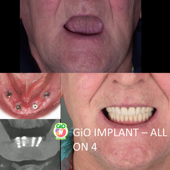 gio-smile-makeover-ceramic-crown-bridge-and-implants