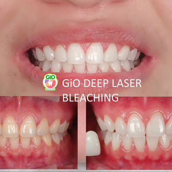 gio-deep-laser-bleaching-2