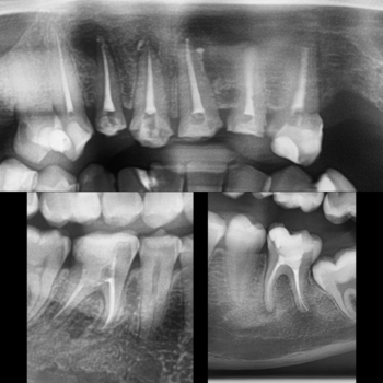 gio-endodontics-perawatan-syaraf-gigi