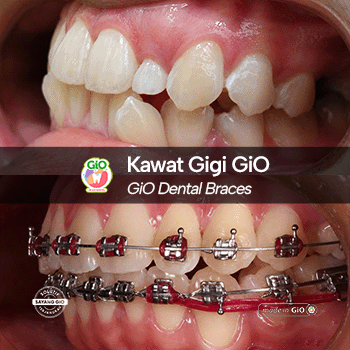 Behel Gigi