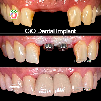 Dental Implant