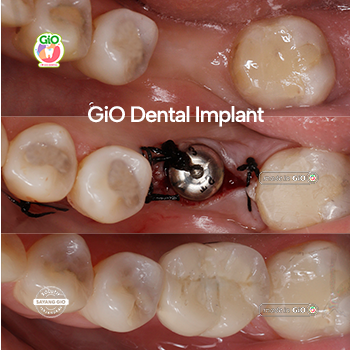 Dental Implant