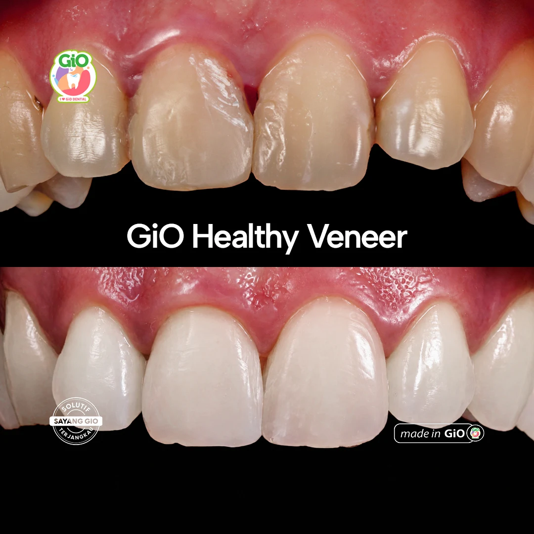Veneer