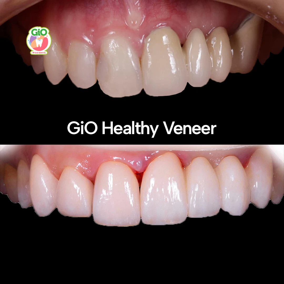 Veneer Gigi