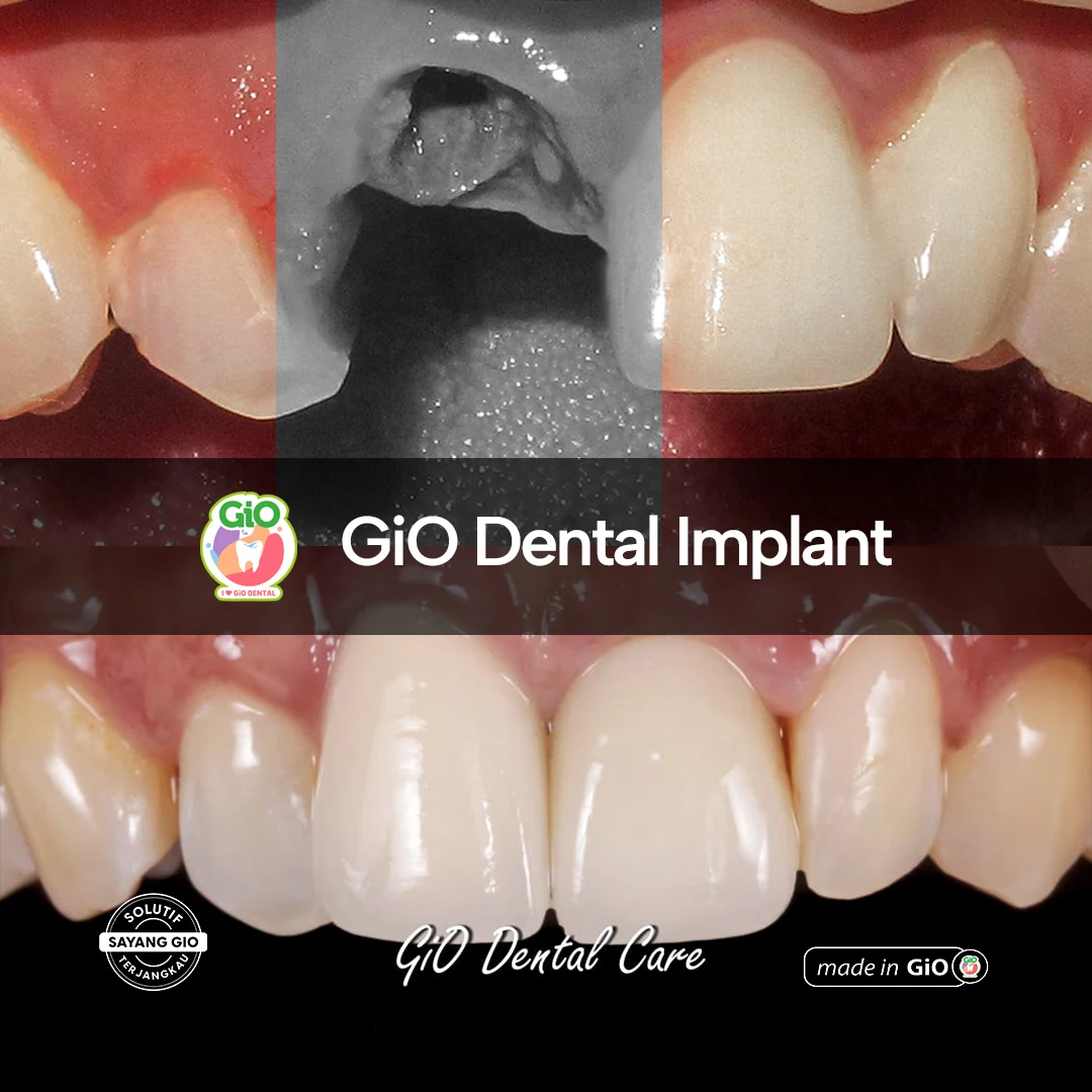GiO Dental Implant