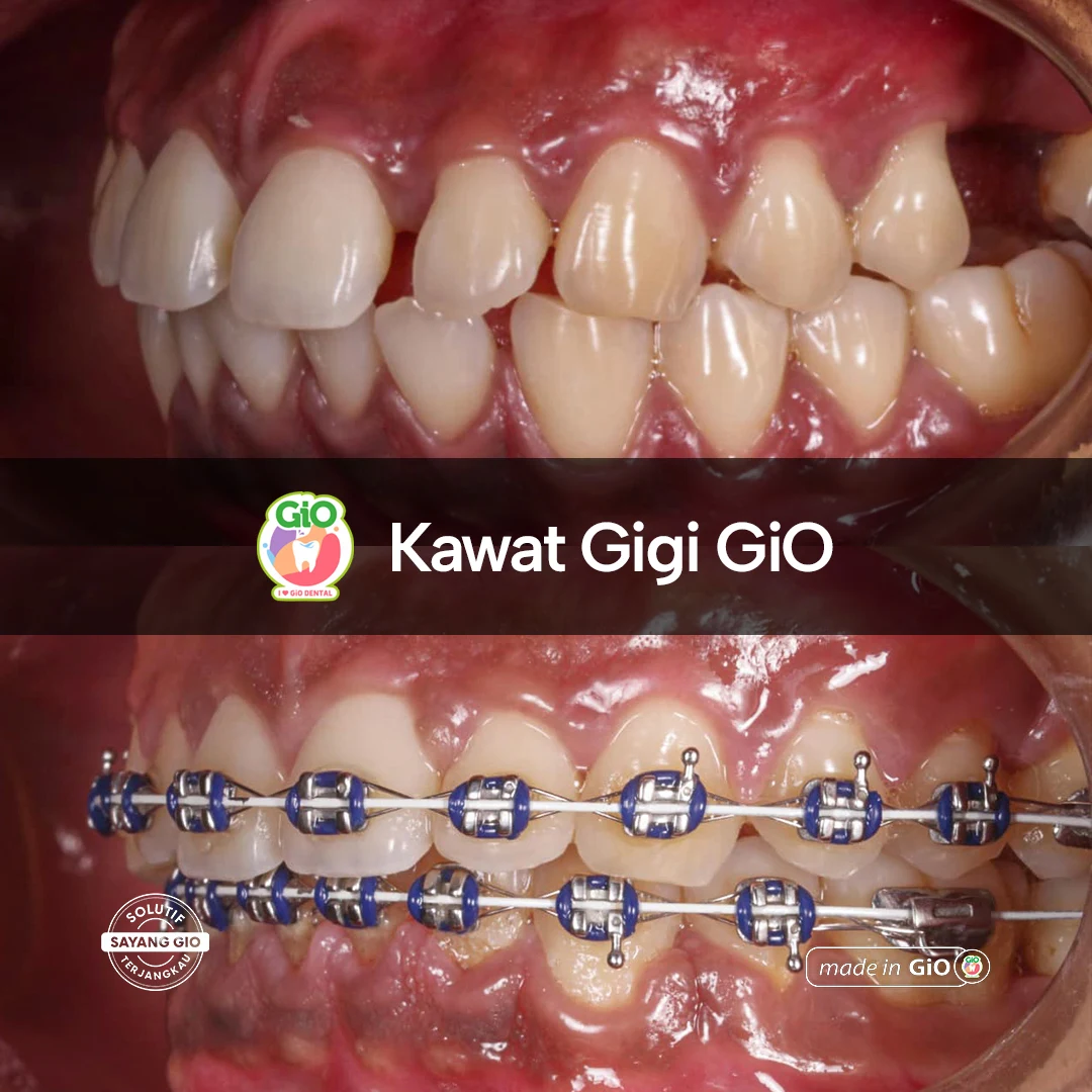 Kawat Gigi GiO