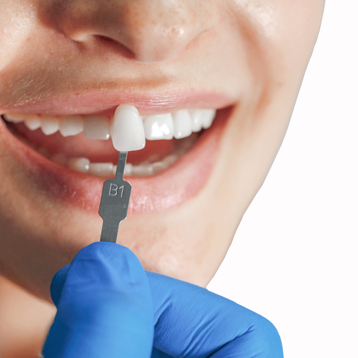 gio-healthy-veneer
