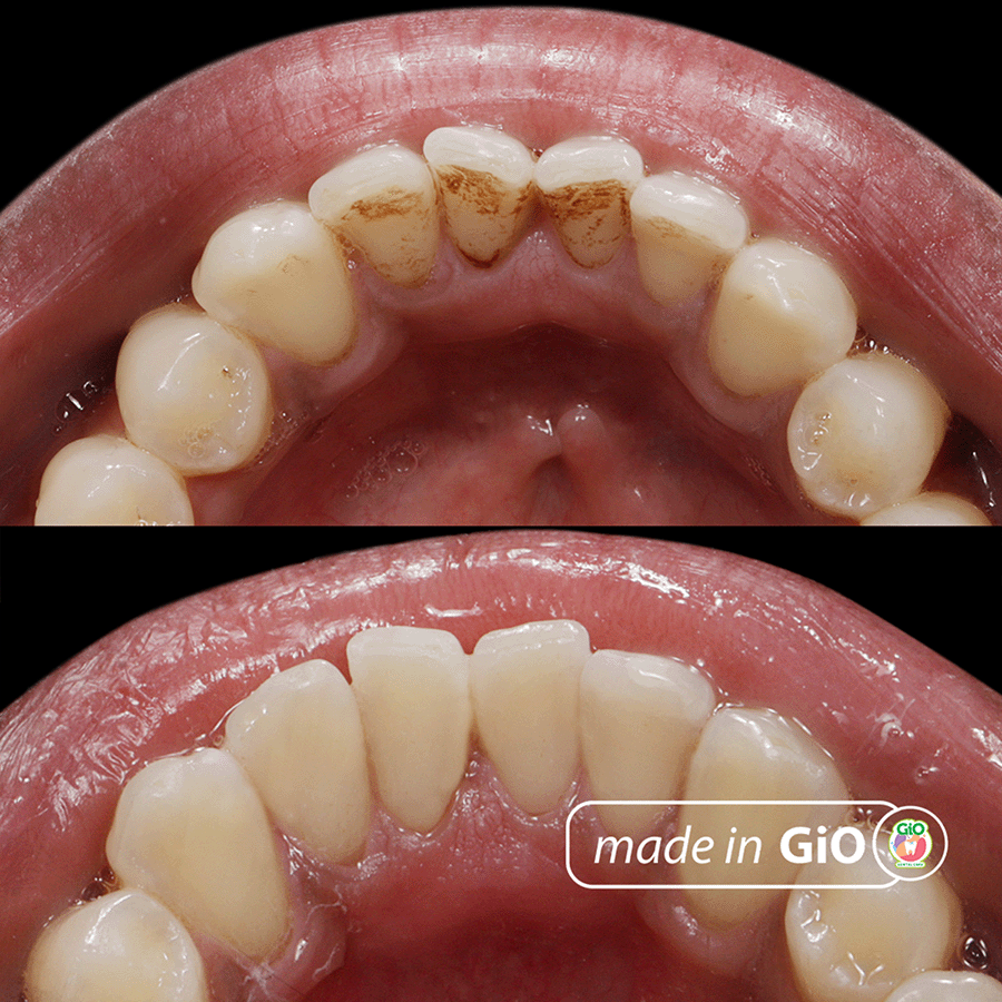 gio-aqua-care-dental-spa-cleaning-scaling