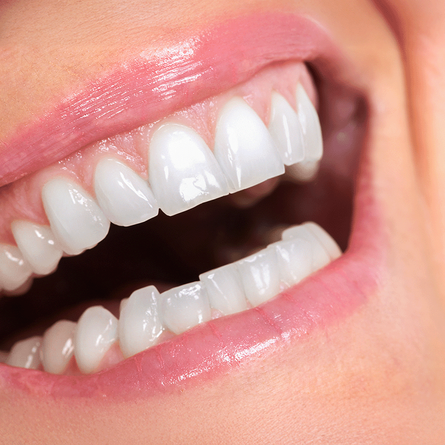 gio-soft-pink-dental-laser-gum-rejuvenation