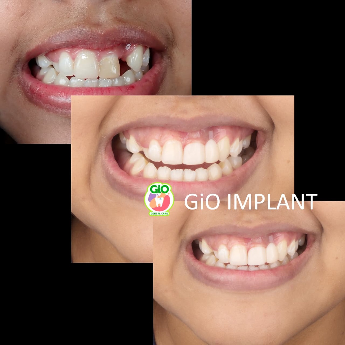 GiO Implant