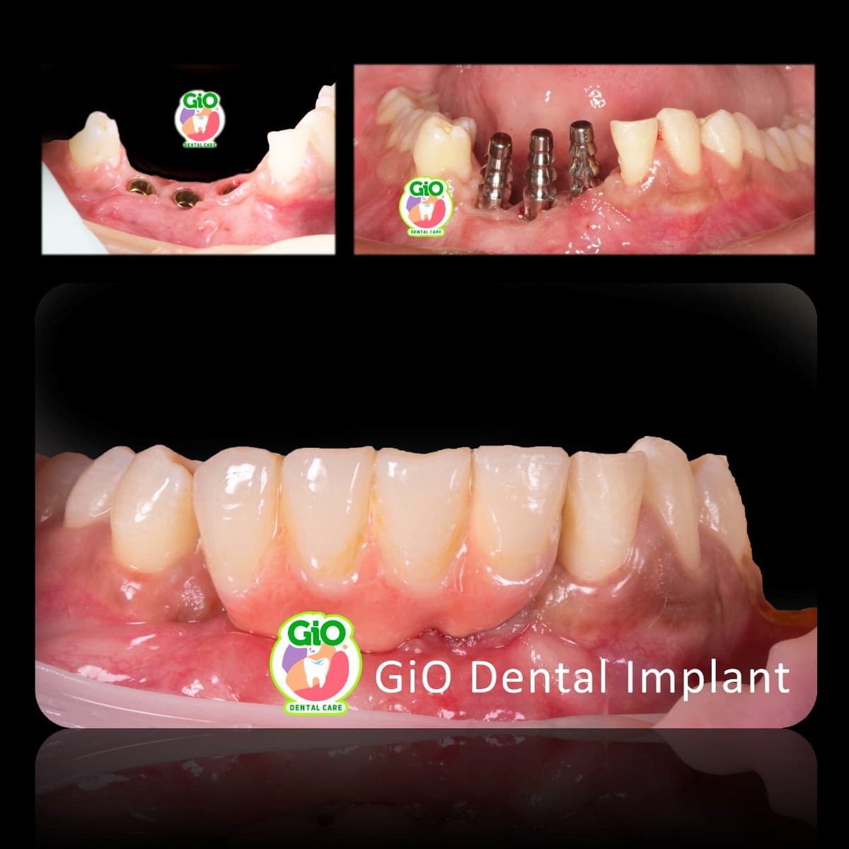 GiO Dental Implant