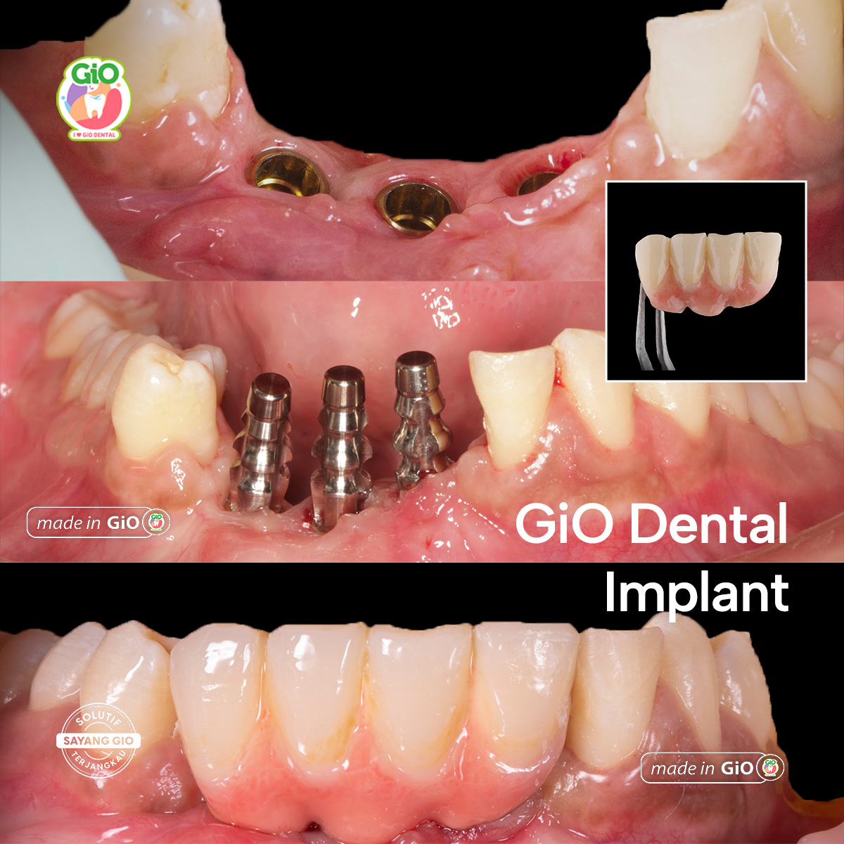 gio-smile-makeover-ceramic-crown-bridge-and-implants