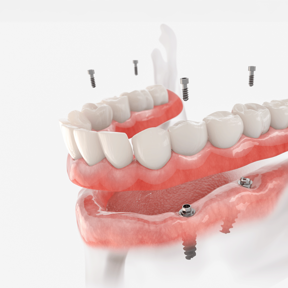 gio-smile-makeover-ceramic-crown-bridge-and-implants