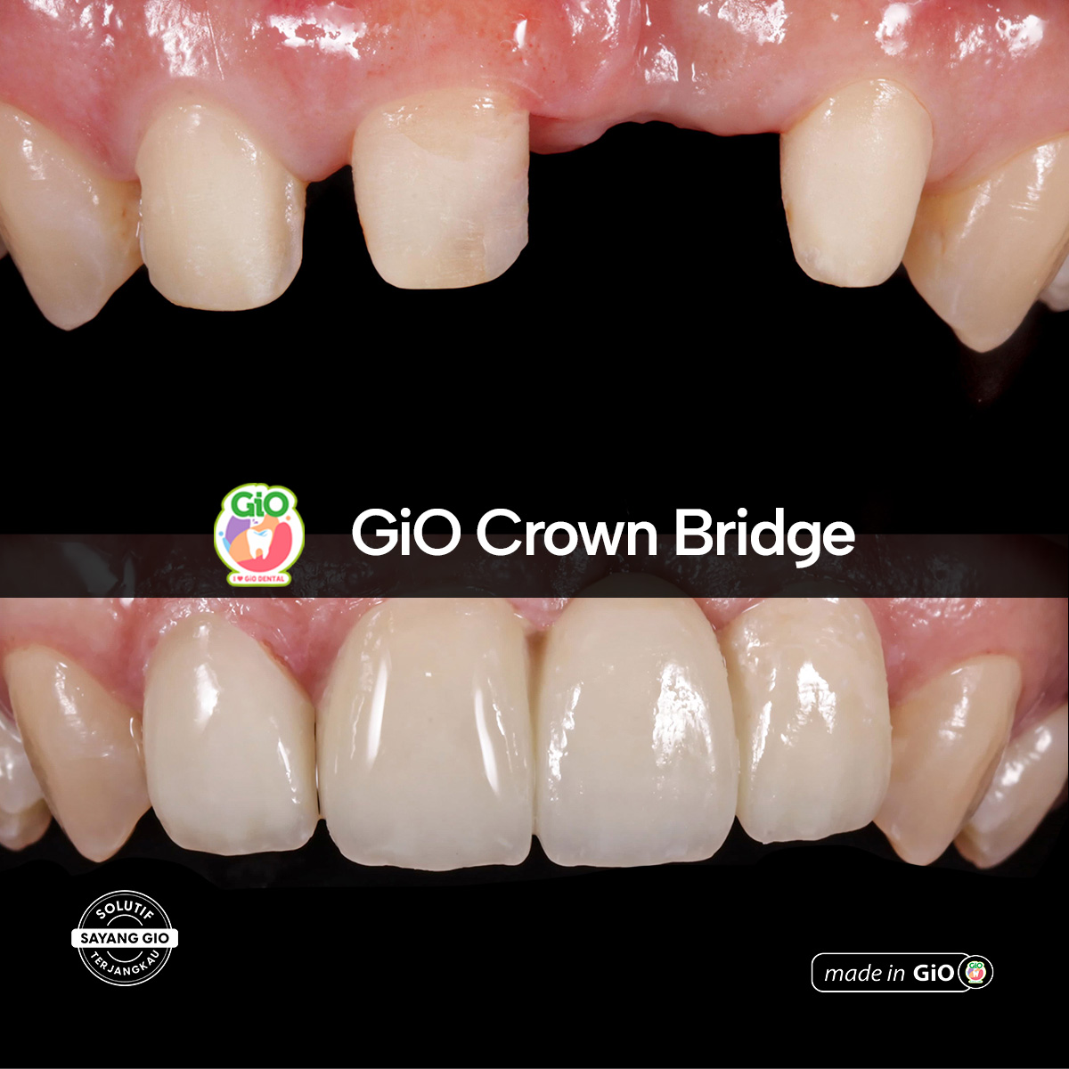 gio-ceramic-crown-bridge-and-implant