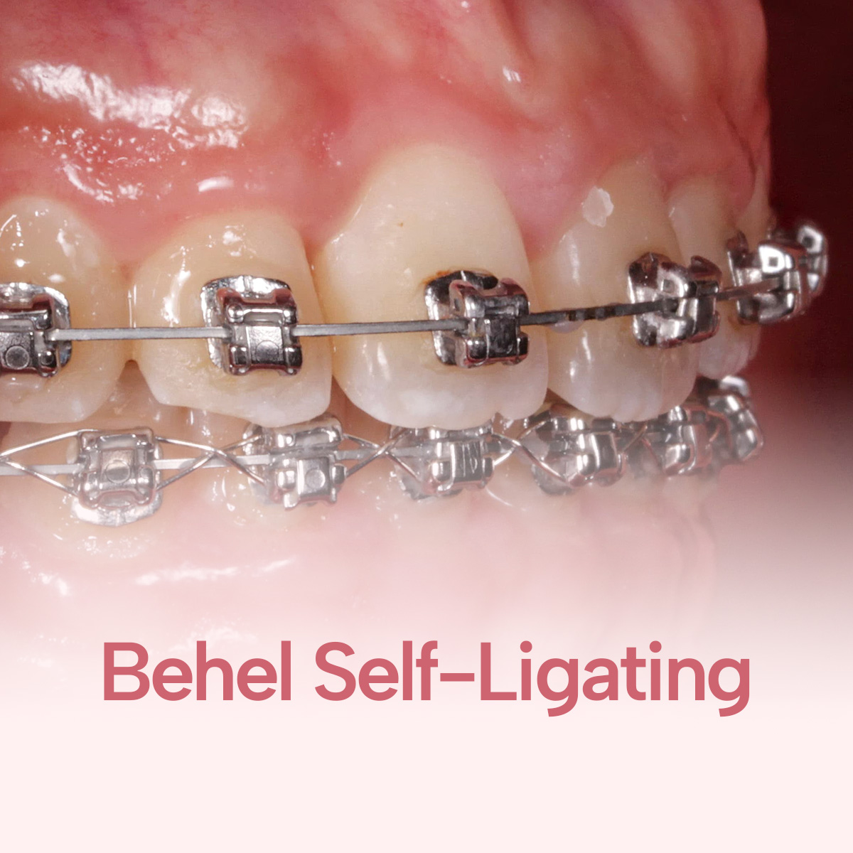 gio-self-ligating-braces