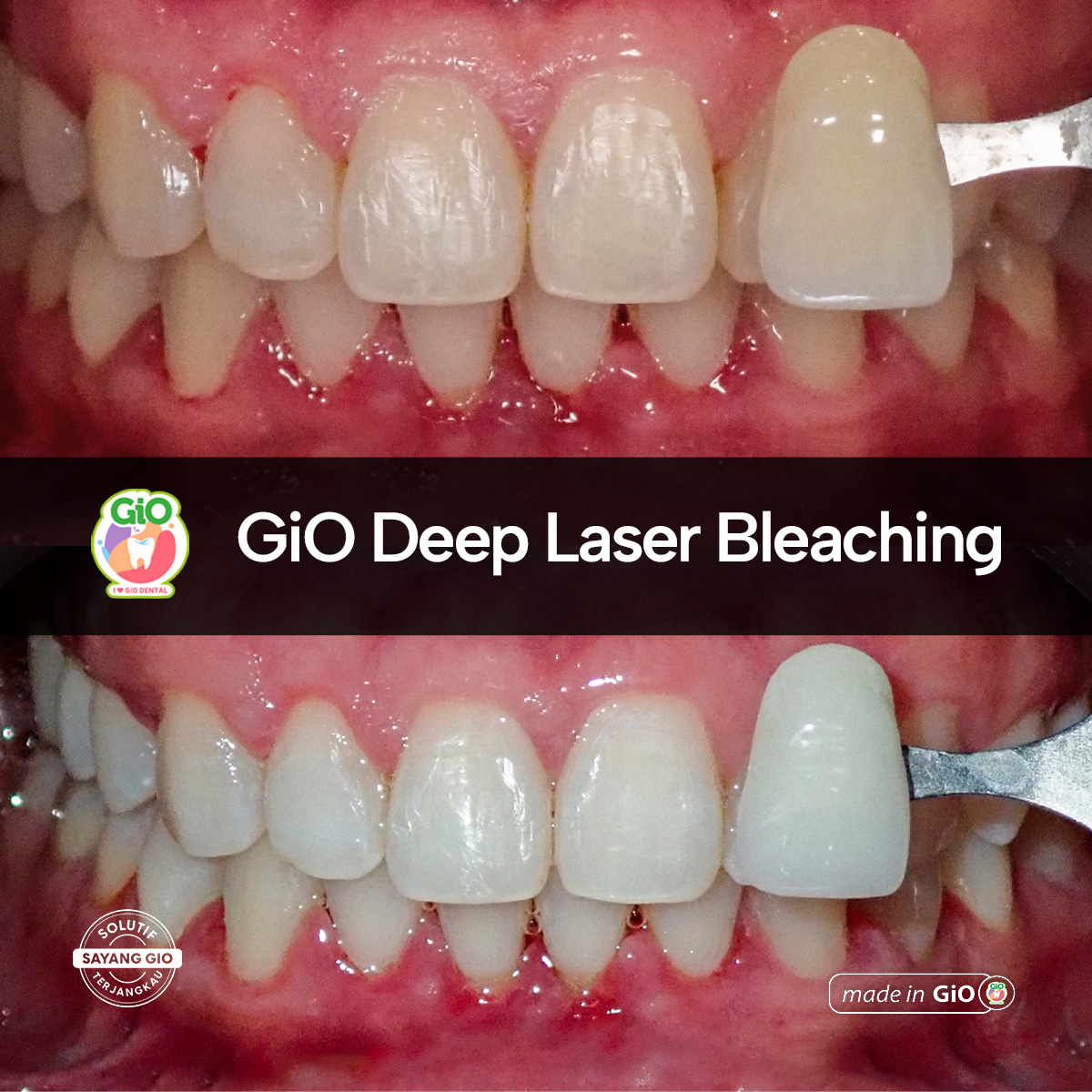 GiO Deep Laser Bleaching
