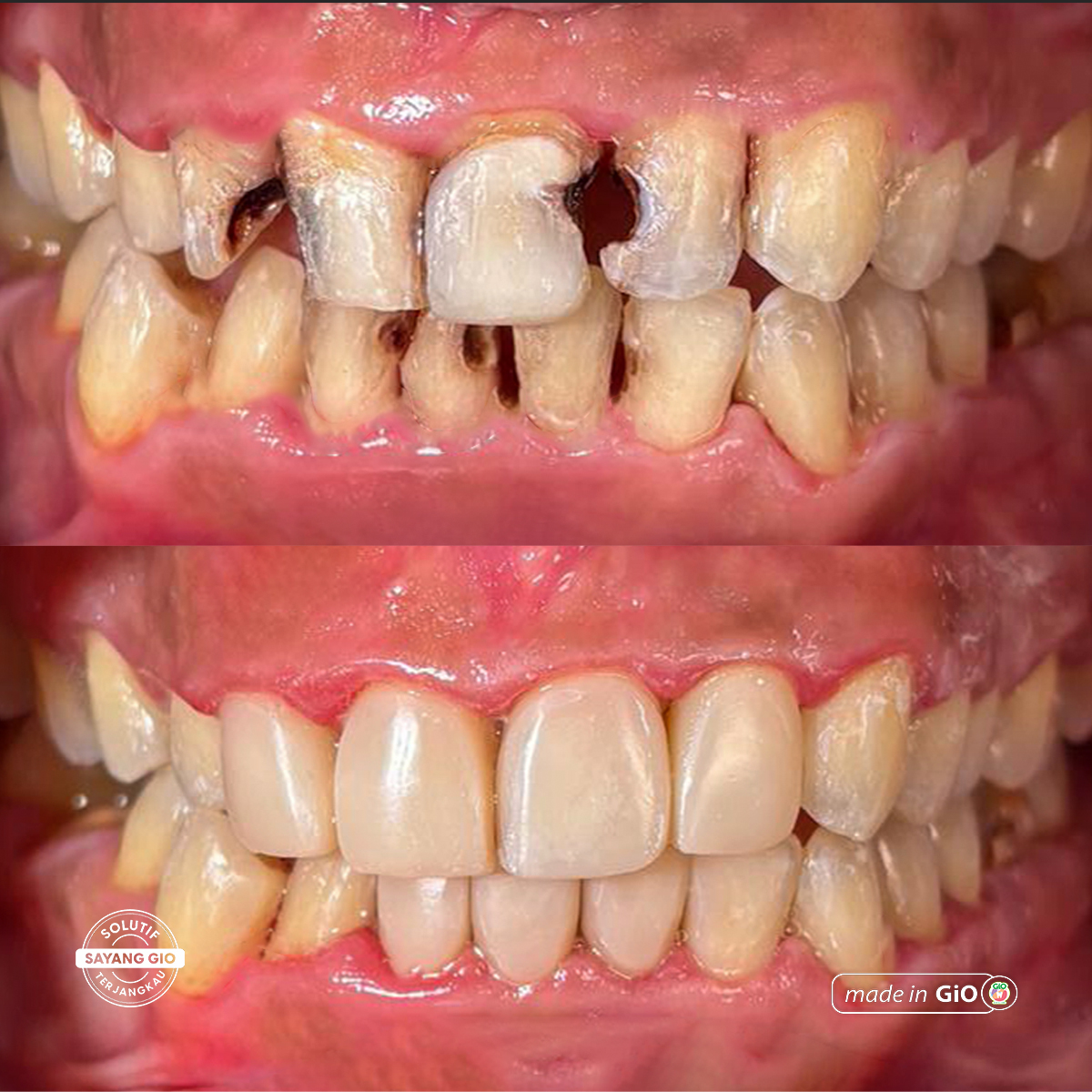 GiO Dental Veneer