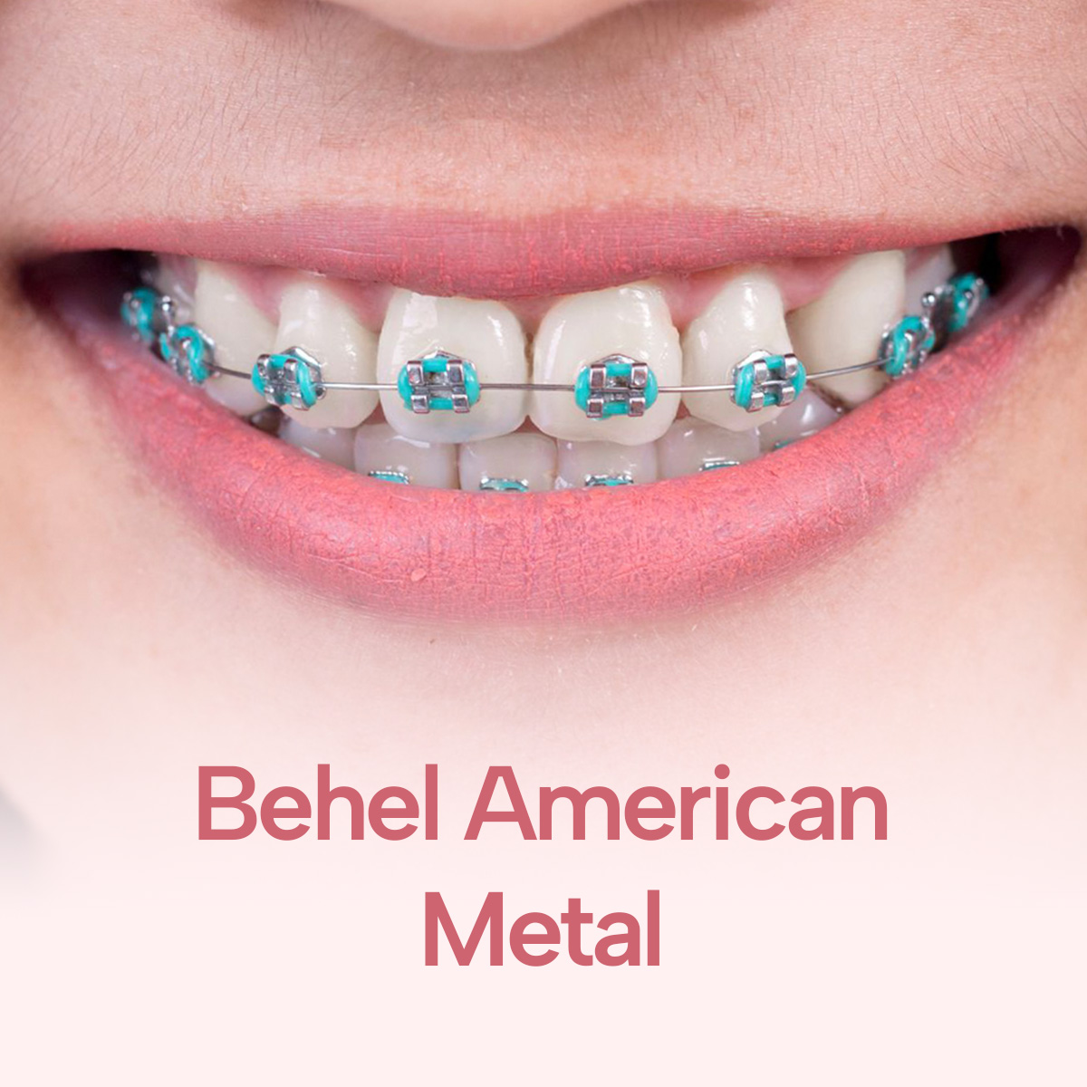 gio-kawat-gigi-american-metal-best-seller