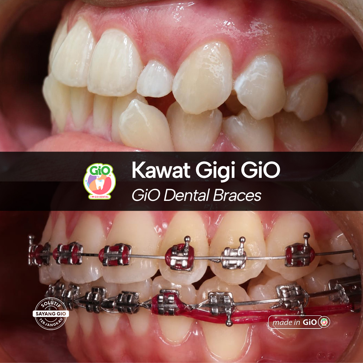 gio-kawat-gigi-american-metal-best-seller