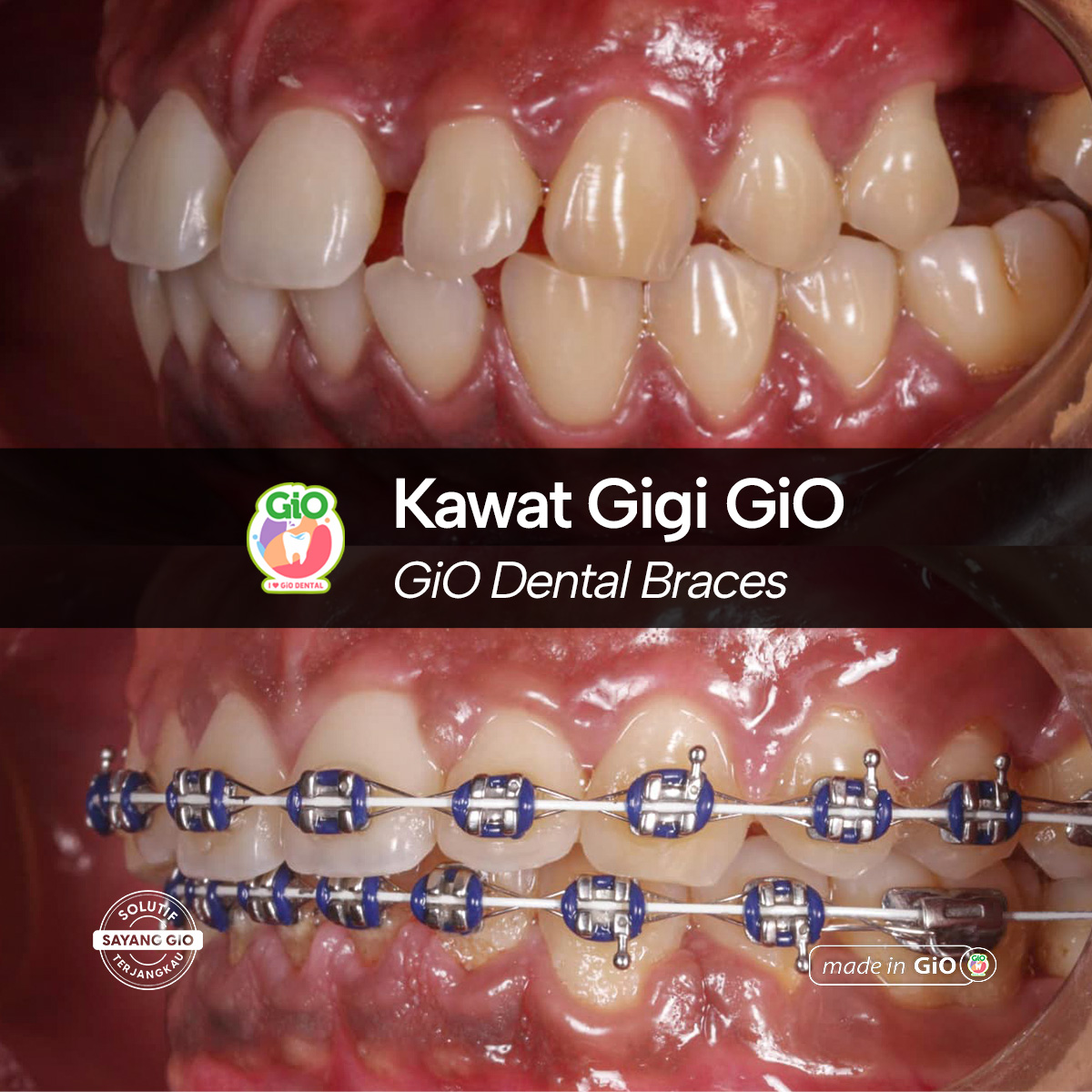 gio-kawat-gigi-american-metal-best-seller