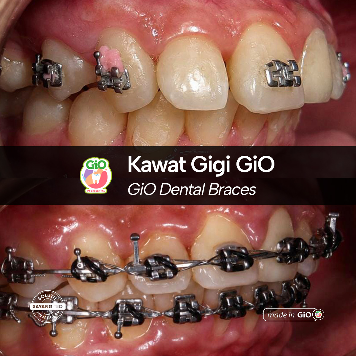 gio-kawat-gigi-american-metal-best-seller