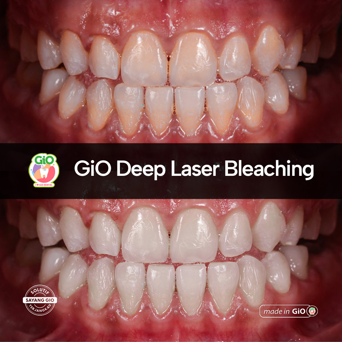 treatment-gio-deep-laser-bleaching