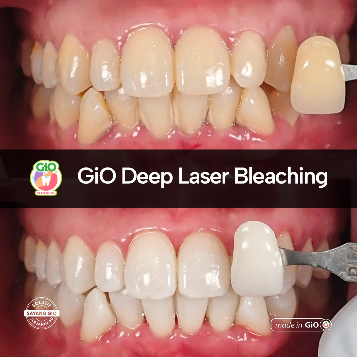 treatment-gio-deep-laser-bleaching