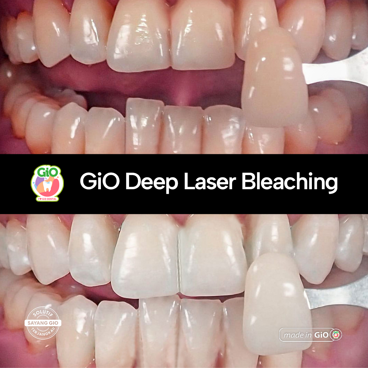 treatment-gio-deep-laser-bleaching