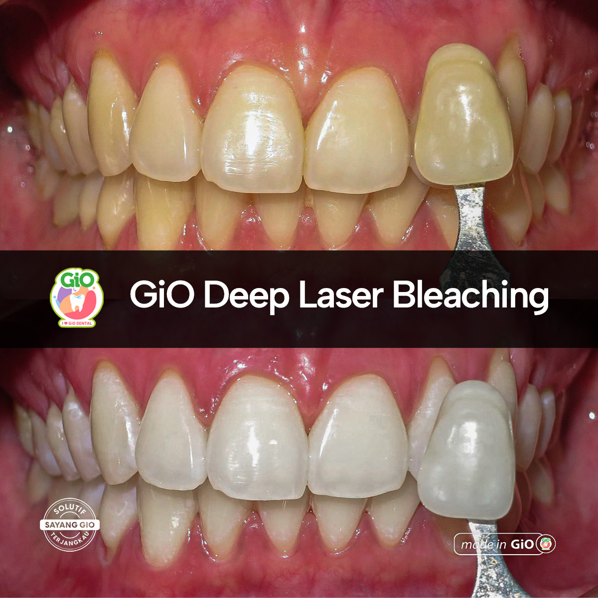 treatment-gio-deep-laser-bleaching